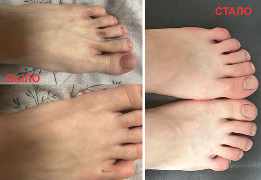 Экзема - ноги, до услуг и после