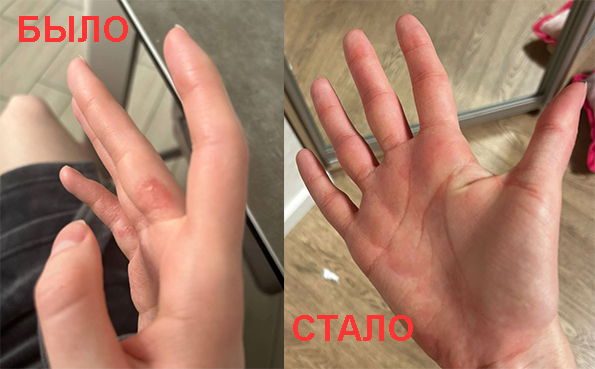 Экзема на руках до услуг и после