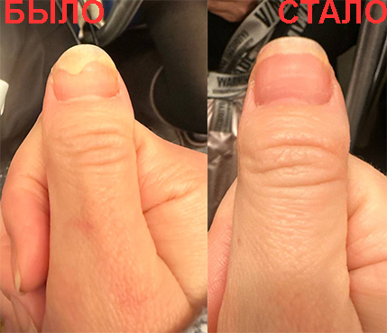 Псориаз ногтей до услуг и после