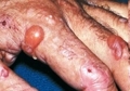 Порфириновая болезнь: 311 нм опасны или не желательны